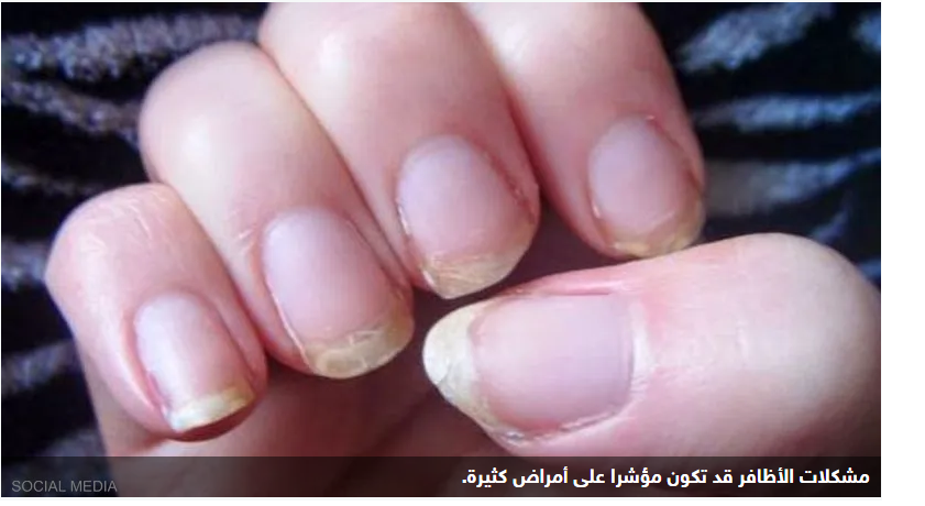 علامة على الأظافر.. انتبه مبكرا لارتفاع نسبة الكوليسترول